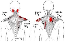 Ambacht Verdragen Gewend aan Pijn tussen de schouderbladen (bovenrug) -